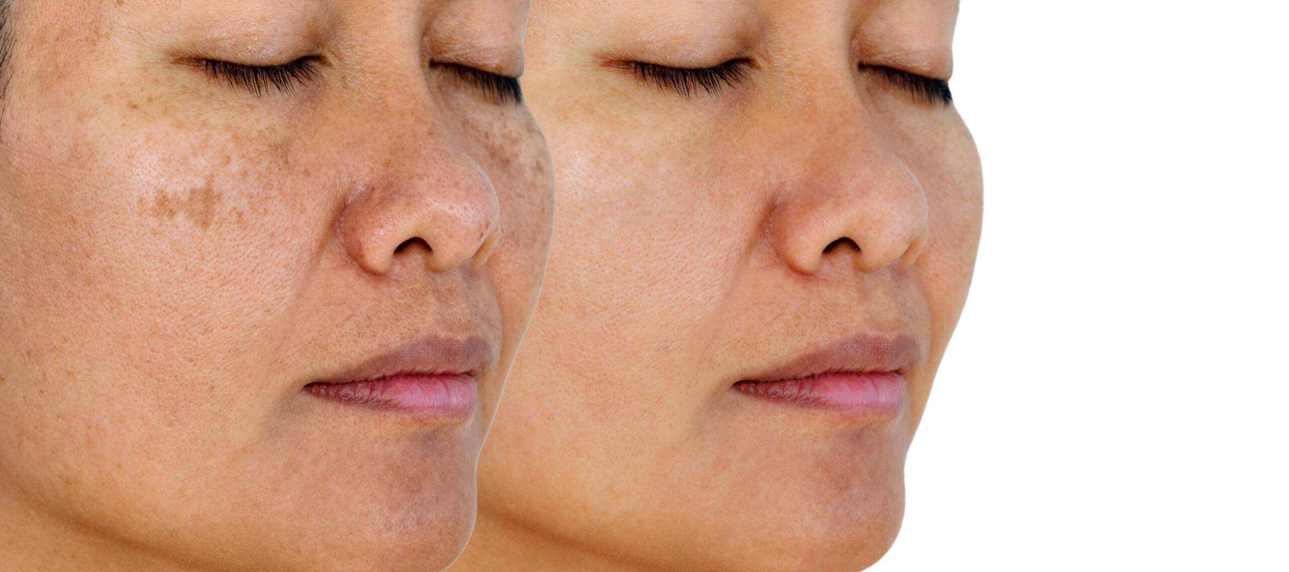 Effective Melasma Pigmentation Treatment In Gurgaon Arka Skin Clinic