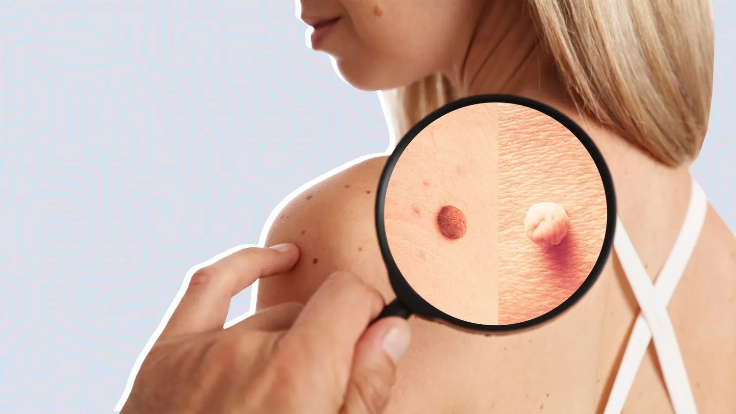 Understanding Warts and Skin Tags: Causes, Types, and Differences