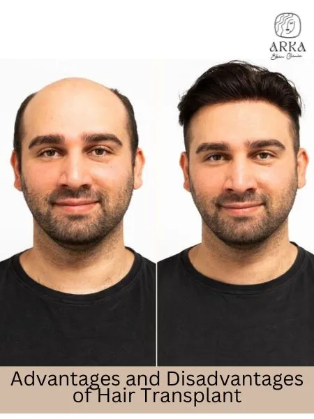 Advantages and Disadvantages of Hair Transplant