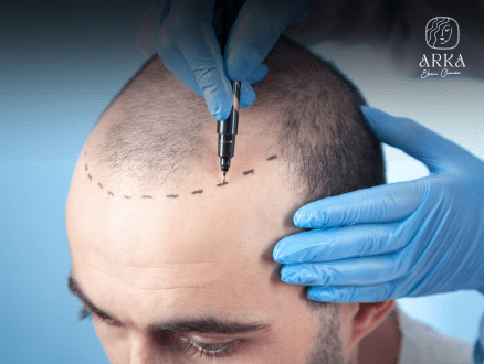 Hair Transplant