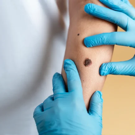 Mole, Wart, and Skin Tag Removal