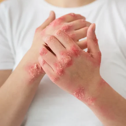 Psoriasis Treatment