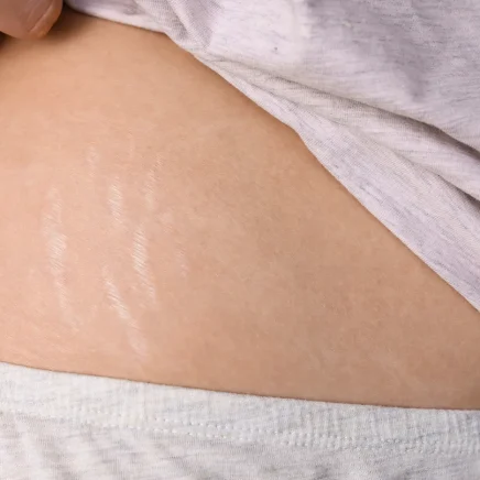Stretch Marks Treatment